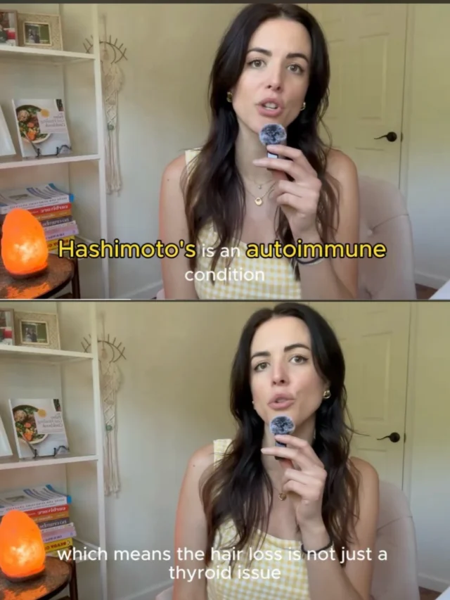 🦋Comment “PLAYLIST” to watch episode 1: “My thyroid labs are ‘normal’, so why am I still losing hair?”

Your thyroid labs come back normal. Your doctor says you’re fine. But you’re still pulling handfuls of hair out in the shower every morning…and nobody can tell you why.

If you have Hashimoto’s and you’re still losing hair despite being on medication and doing “everything right,” this video is going to change how you understand your situation. 

Thyroid hair loss is not just a thyroid problem, and treating it like one is exactly why so many women stay stuck.

In this video I’m covering:
→ Why “normal” thyroid labs don’t tell the whole story
→ The 3 systems driving Hashimoto’s hair loss that most doctors never check
→ Why thyroid symptoms like hair loss persist even on medication like Synthroid (Levo) or Armour (NDT)

This is the first video in my Hashimoto’s Hair Loss playlist — watch all 5 to get the full root-cause picture.💕

#hashimotos #hashimotoshairloss #hypothyroid #hypothyroidhairloss #autoimmunedisease